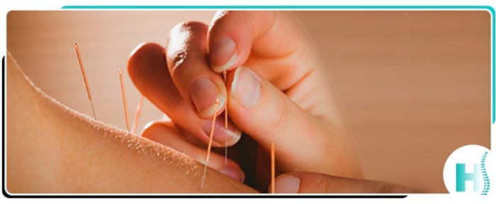 Acupuncture Therapy Near Me in Hoboken, NJ