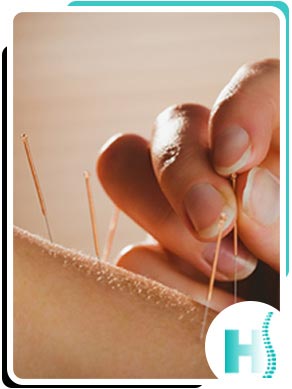 Acupuncture Services Near Me in Hoboken, NJ