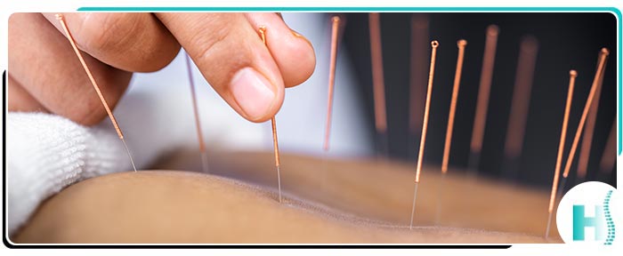 Acupuncture Treatment Specialist for Back Pain Near Me in Hoboken, NJ