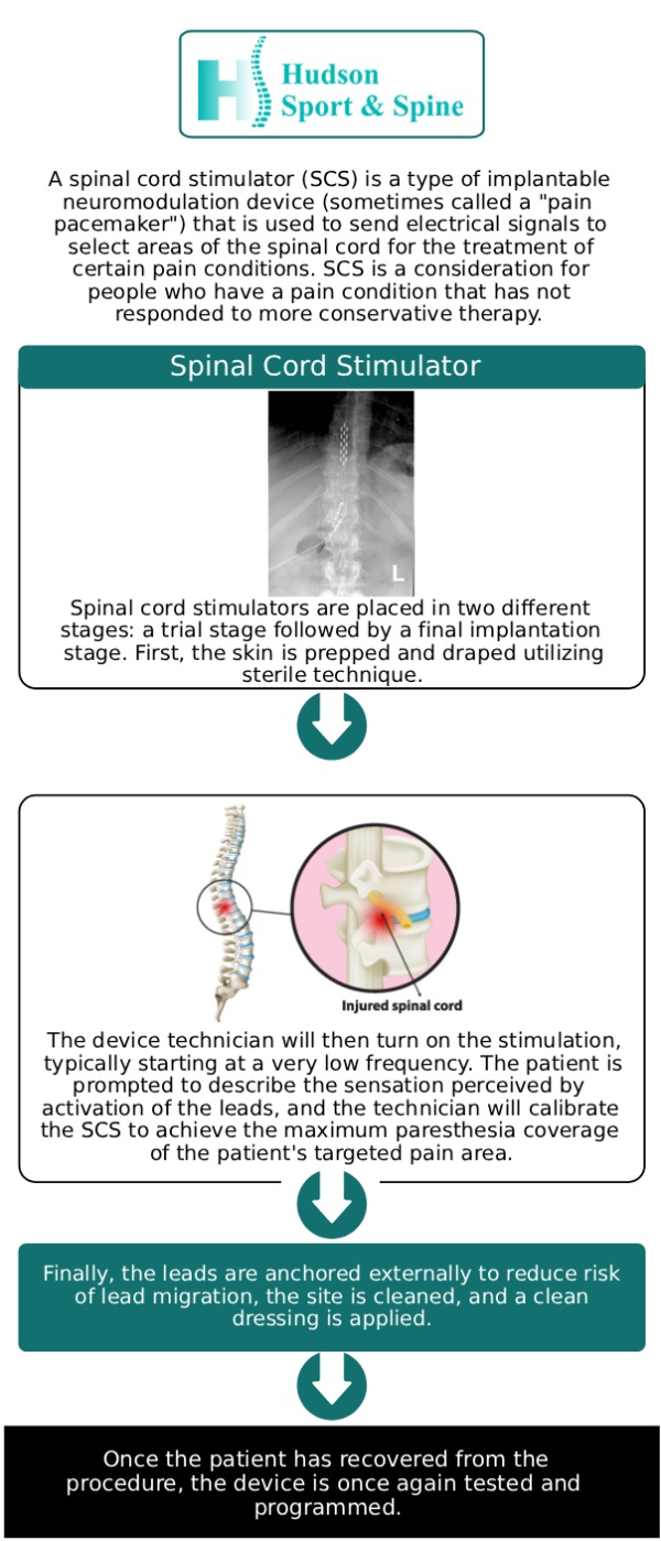Chronic back pain and nerve-related discomfort can significantly impact quality of life, especially when conventional treatments fail to provide relief. For patients with persistent pain, a Spinal Cord Stimulator (SCS) may offer a minimally invasive, highly effective solution. At Hudson Sport & Spine, our team specializes in evaluating candidates for SCS therapy and providing expert guidance on whether this advanced treatment can improve comfort, mobility, and daily function. Contact us for more information or book an appointment online! today. We are conveniently located at 70 Hudson St Suite 2B, Hoboken, NJ 07030. Chronic back pain and nerve-related discomfort can significantly impact quality of life, especially when conventional treatments fail to provide relief. For patients with persistent pain, a Spinal Cord Stimulator (SCS) may offer a minimally invasive, highly effective solution. At Hudson Sport & Spine, our team specializes in evaluating candidates for SCS therapy and providing expert guidance on whether this advanced treatment can improve comfort, mobility, and daily function. Contact us for more information or book an appointment online! today. We are conveniently located at 70 Hudson St Suite 2B, Hoboken, NJ 07030.